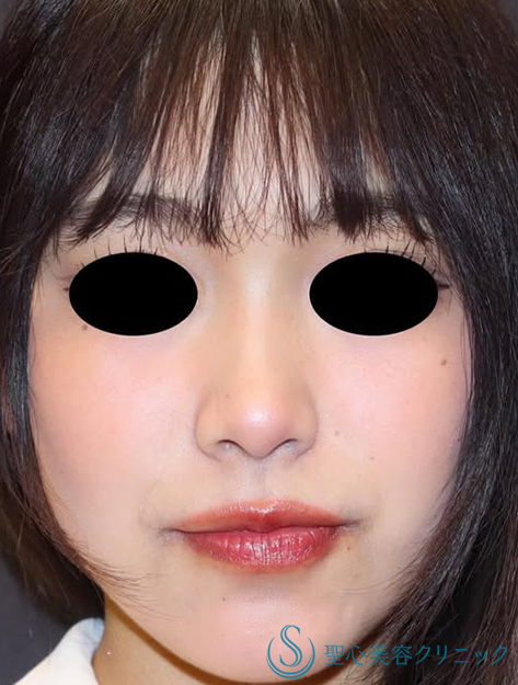 【20代女性・ナチュラルな小鼻】小鼻縮小（術後2ヶ月） After 