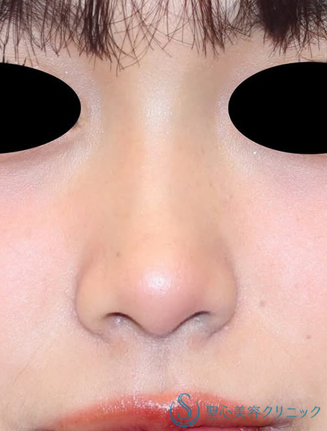【20代女性・ナチュラルな小鼻】小鼻縮小（術後2ヶ月） After 