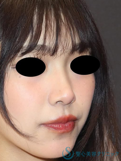 【20代女性・ナチュラルな小鼻】小鼻縮小（術後2ヶ月） After 