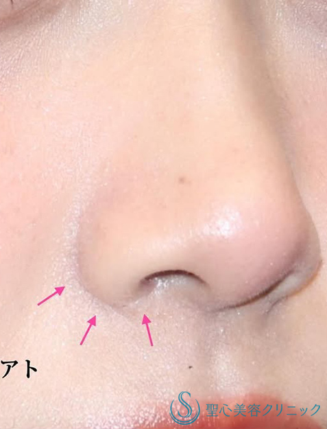 【20代女性・ナチュラルな小鼻】小鼻縮小（術後2ヶ月） After 