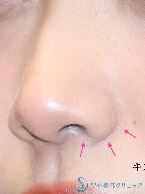【20代女性・ナチュラルな小鼻】小鼻縮小（術後2ヶ月） After 