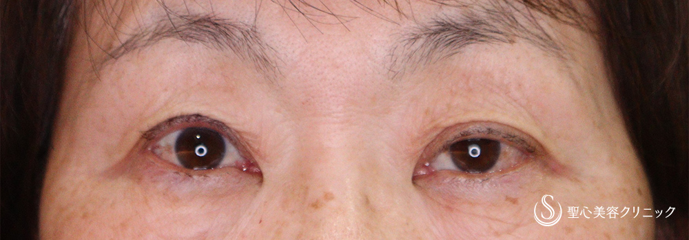 【60代女性・右目の眼瞼下垂を改善】眼瞼下垂（埋没法）（1ヶ月後） After 
