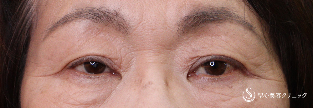 【60代女性・右目の眼瞼下垂を改善】眼瞼下垂（埋没法）（1ヶ月後） After 