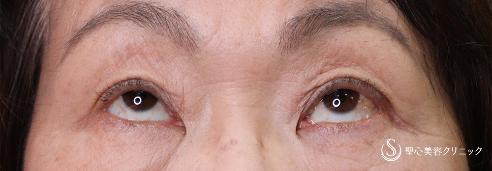 【60代女性・右目の眼瞼下垂を改善】眼瞼下垂（埋没法）（1ヶ月後） After 