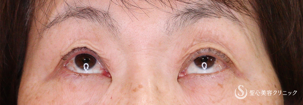 【60代女性・右目の眼瞼下垂を改善】眼瞼下垂（埋没法）（1ヶ月後） After 