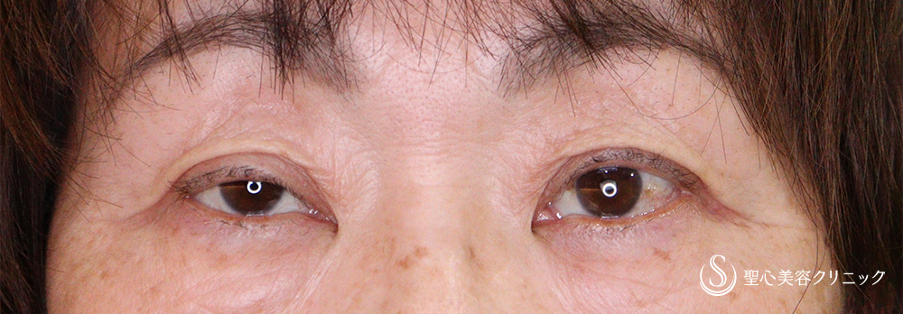 【60代女性・右目の眼瞼下垂を改善】眼瞼下垂（埋没法）（1ヶ月後） Before 