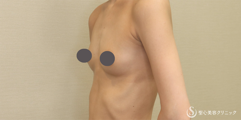 【20代女性・理想のバストへボリュームアップ】バッグプロテーゼ挿入法（モティバ180cc）（1ヶ月後） Before 