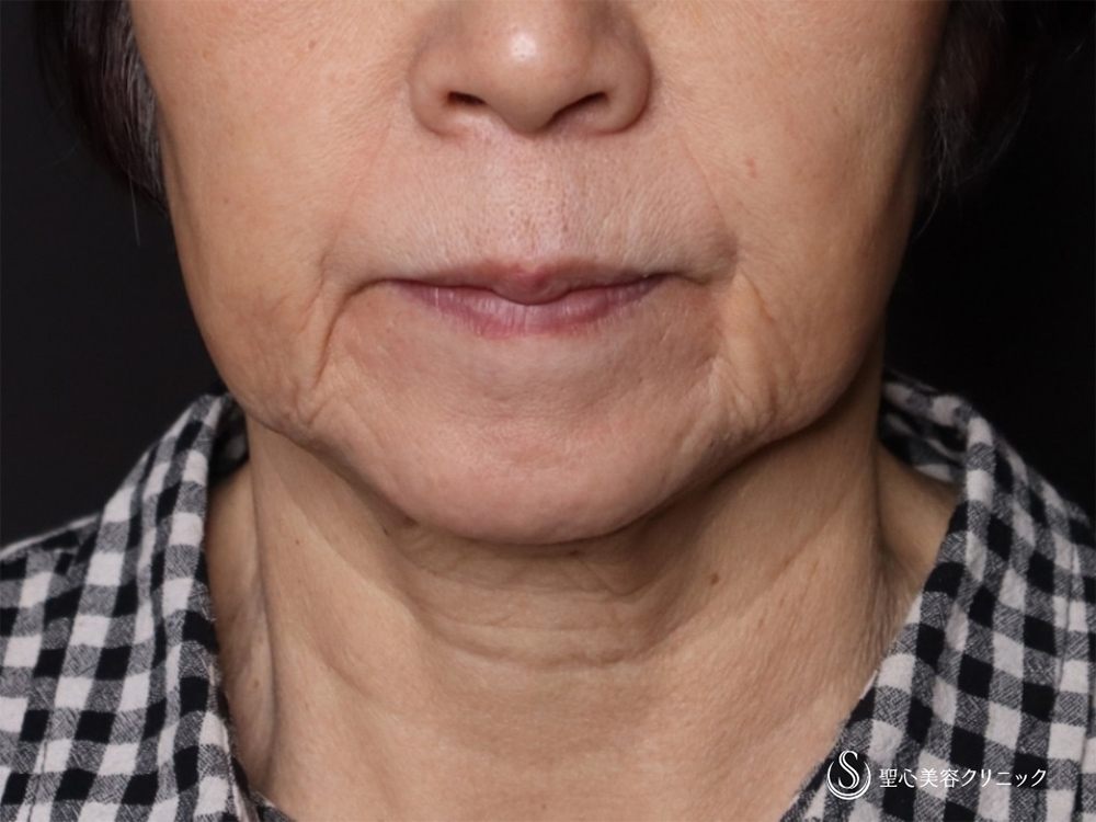 【70代女性・口元のたるみやフェイスラインもスッキリ】プレミアムミニリフト＋ネックリフト＋頬、顎下脂肪吸引注射（1ヶ月後） Before 
