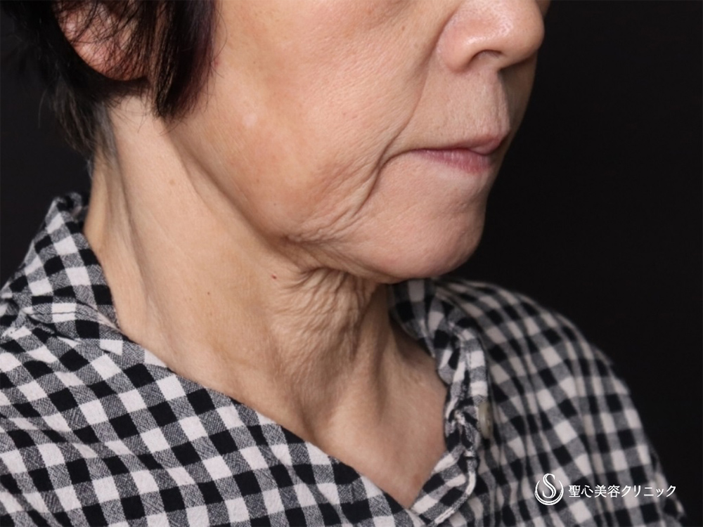 【70代女性・口元のたるみやフェイスラインもスッキリ】プレミアムミニリフト＋ネックリフト＋頬、顎下脂肪吸引注射（1ヶ月後） Before 