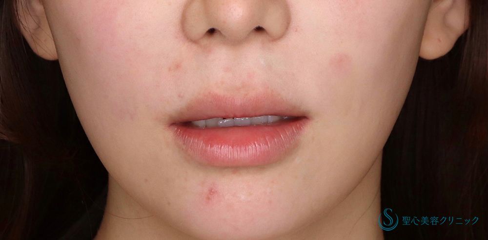 【20代女性・人中を短くしたい】プレミアムリップリフト（プレミアム人中短縮術）（1ヶ月後） Before 