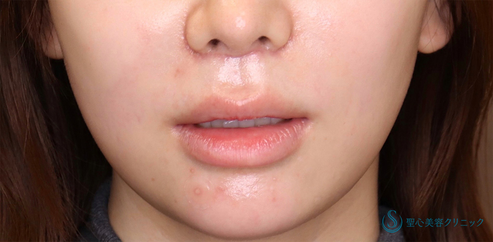 【20代女性・人中を短くしたい】プレミアムリップリフト（プレミアム人中短縮術）（1ヶ月後） After 