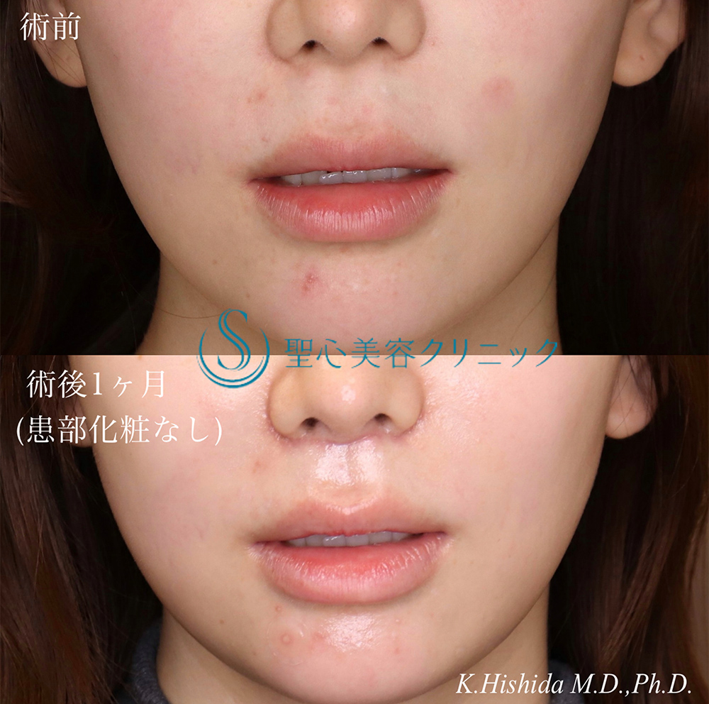 【20代女性・人中を短くしたい】プレミアムリップリフト（プレミアム人中短縮術）（1ヶ月後） After 