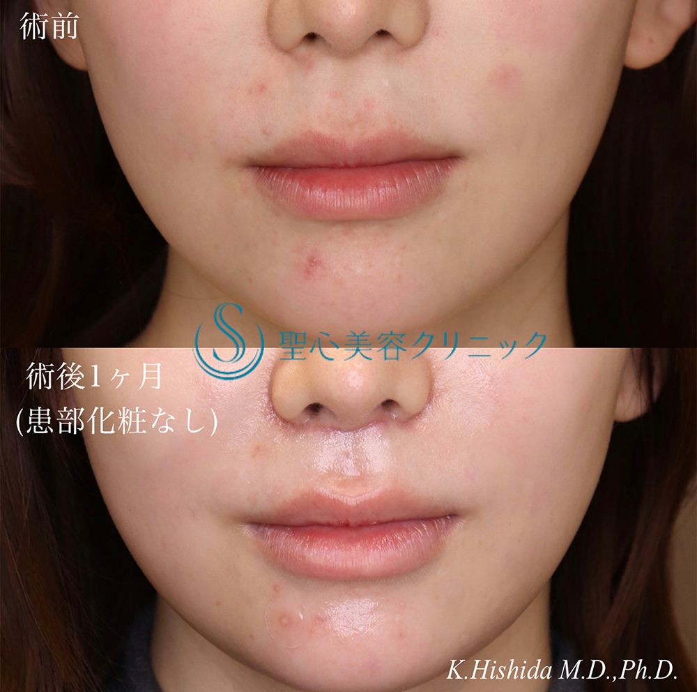 【20代女性・人中を短くしたい】プレミアムリップリフト（プレミアム人中短縮術）（1ヶ月後） After 