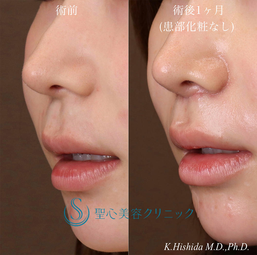 【20代女性・人中を短くしたい】プレミアムリップリフト（プレミアム人中短縮術）（1ヶ月後） After 