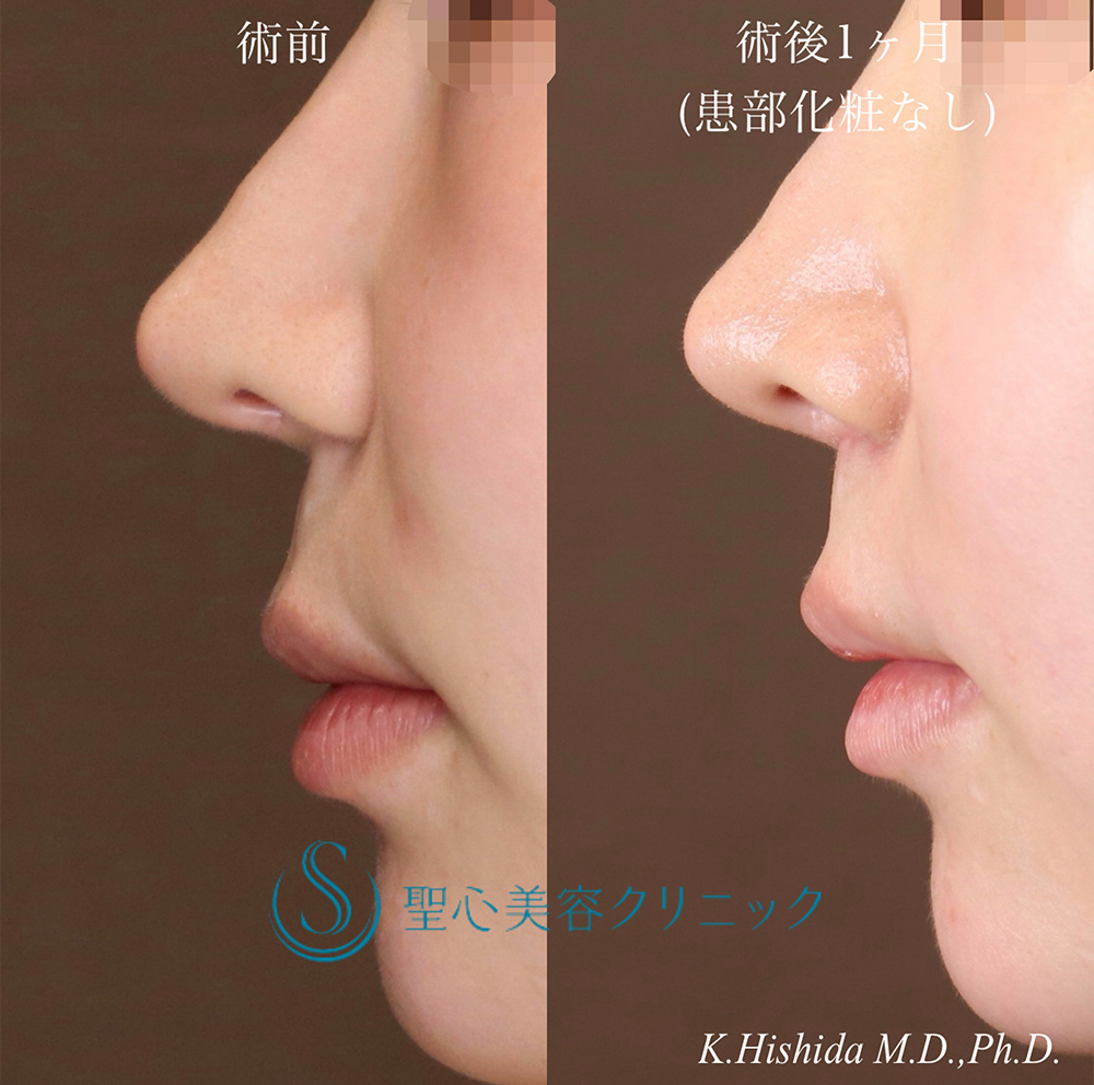 【20代女性・人中を短くしたい】プレミアムリップリフト（プレミアム人中短縮術）（1ヶ月後） After 