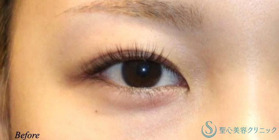 【20代女性・蒙古ヒダを切除し自然な二重に】目上切開（術後1ヶ月） Before 