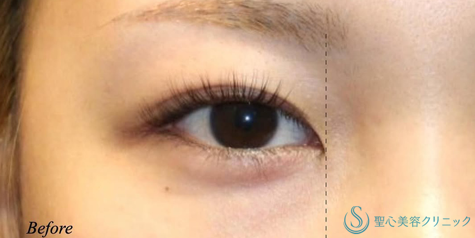 【20代女性・蒙古ヒダを切除し自然な二重に】目上切開（術後1ヶ月） Before 