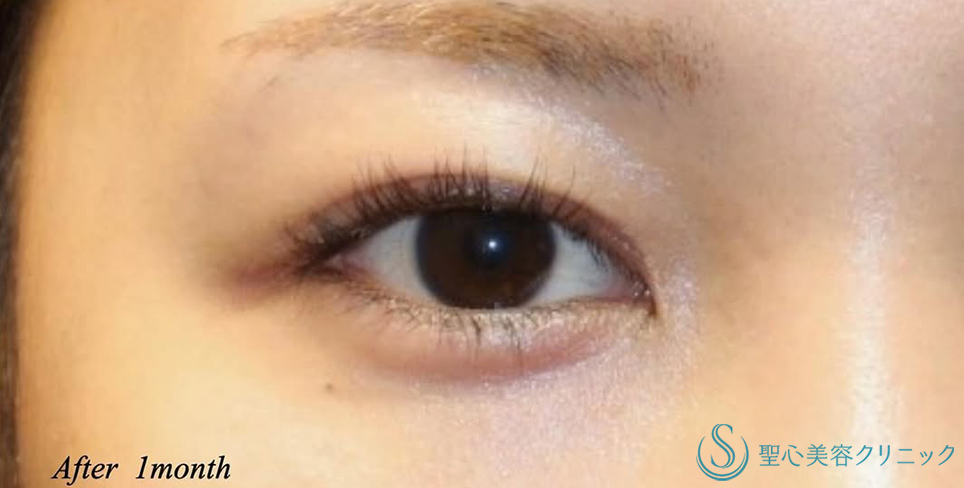 【20代女性・蒙古ヒダを切除し自然な二重に】目上切開（術後1ヶ月） After 