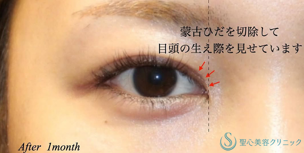 【20代女性・蒙古ヒダを切除し自然な二重に】目上切開（術後1ヶ月） After 