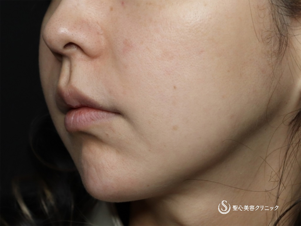 脂肪吸引注射＋アンカーMAX_Before