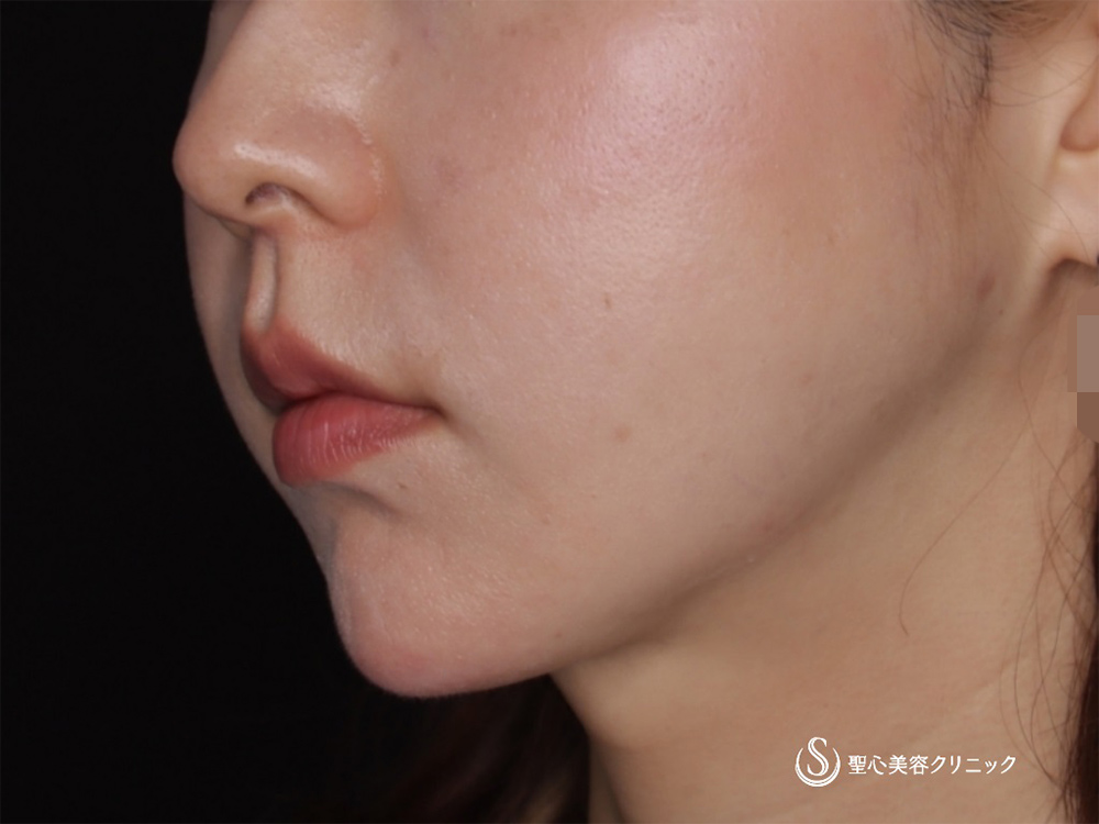 脂肪吸引注射＋アンカーMAX_After