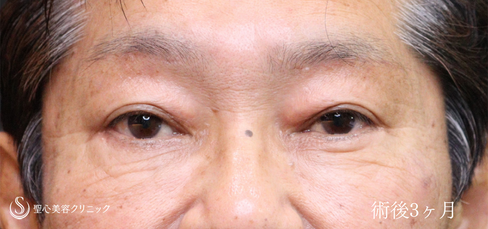 【60代男性・目周りのアンチエイジング】ハムラ法＋眉下切開法（眉下リフト）（3ヶ月後） After 