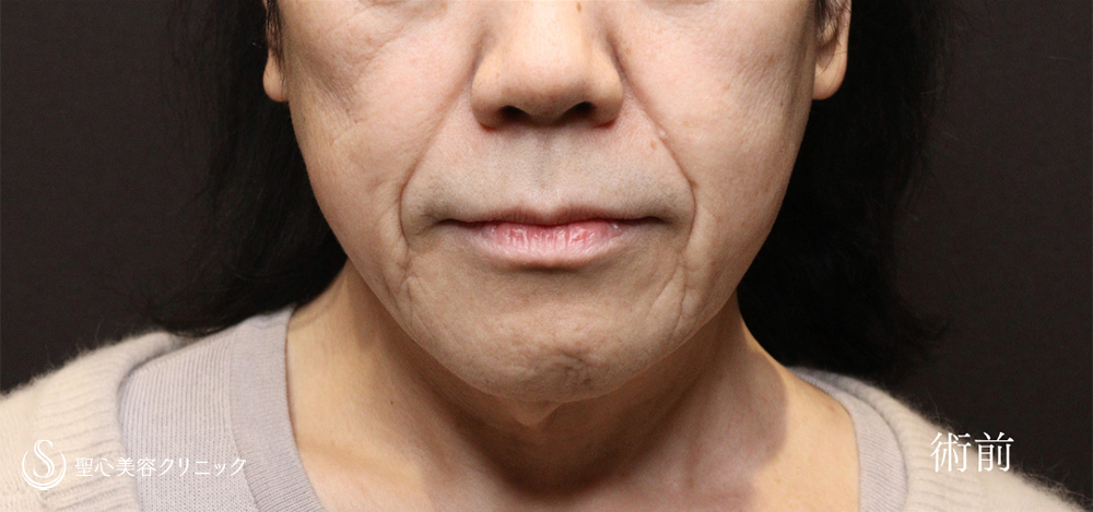 【50代女性・フェイスラインをしっかり改善】フェイスリフト＋ 脂肪吸引注射（頬＋顎下）（1ヶ月後） Before 