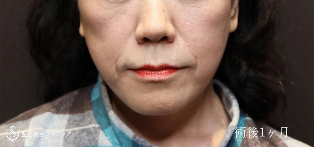 【50代女性・フェイスラインをしっかり改善】フェイスリフト＋ 脂肪吸引注射（頬＋顎下）（1ヶ月後） After 