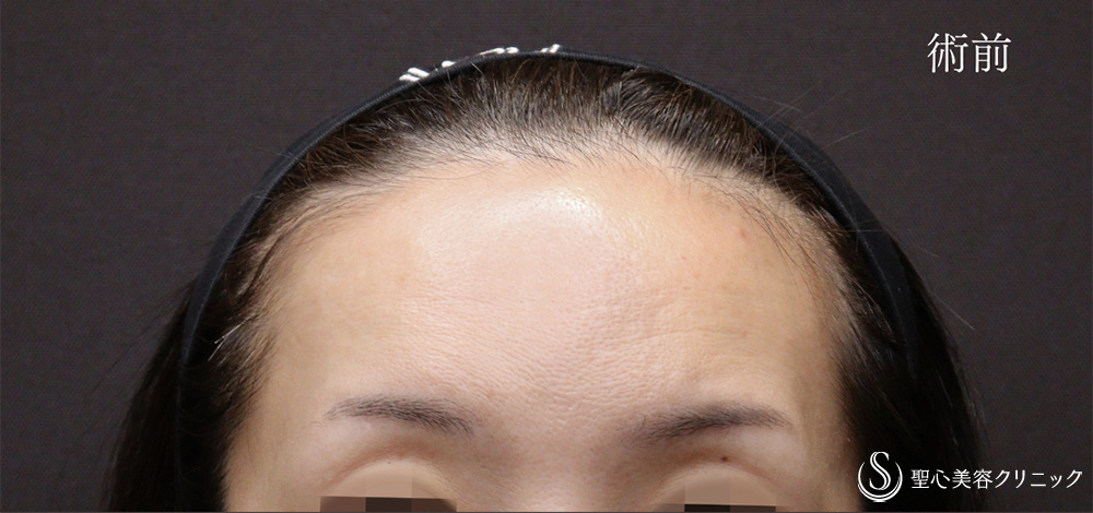 【30代女性・プレミアムPRP皮膚再生療法で額にハリを】プレミアムPRP皮膚再生療法（5ヶ月後） Before 