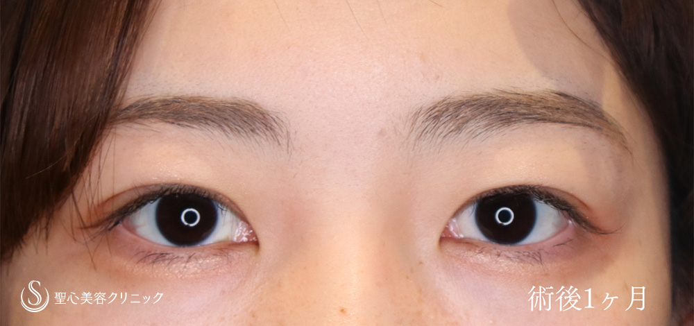 【20代女性・埋没法でお目元を華やかに】 マイクロメソッド+α（二重埋没法）（1ヶ月後） After 
