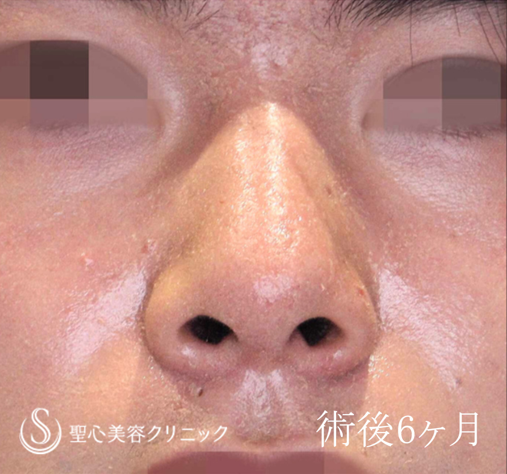 【10代男性・ストラットで鼻先をスッキリ、高く】鼻尖形成（耳介軟骨移植）＋鼻尖縮小（6ヶ月後） After 