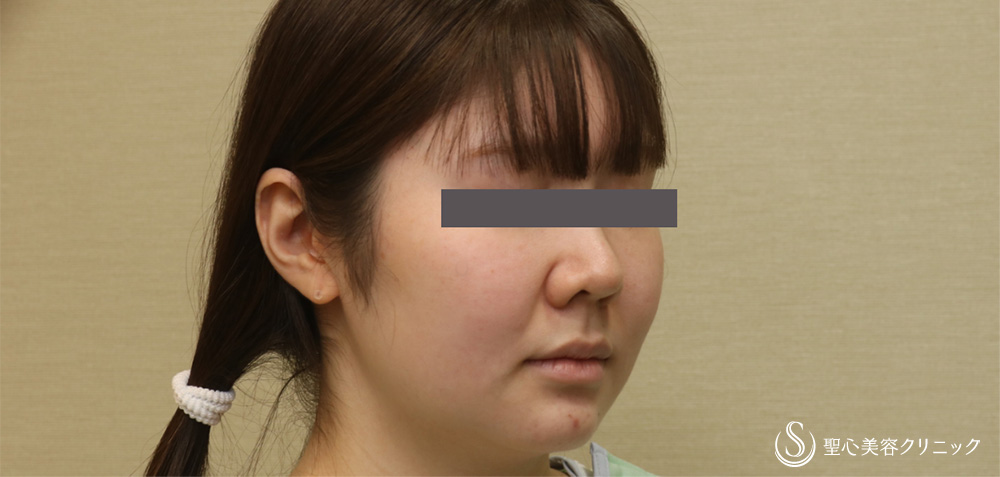 【20代女性・頬顎下スッキリ】脂肪吸引注射（頬＋顎下）（4ヶ月後） Before 