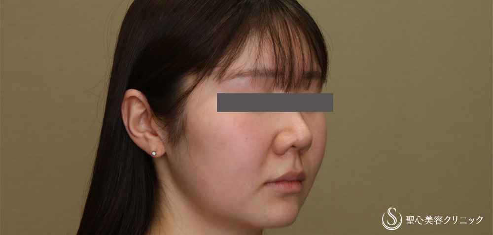【20代女性・頬顎下スッキリ】脂肪吸引注射（頬＋顎下）（4ヶ月後） After 