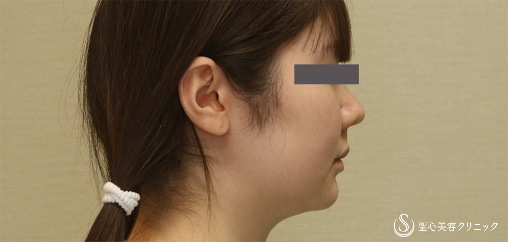 【20代女性・頬顎下スッキリ】脂肪吸引注射（頬＋顎下）（4ヶ月後） Before 