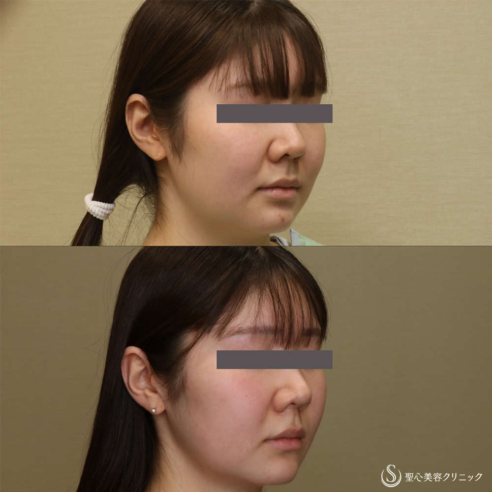 【20代女性・頬顎下スッキリ】脂肪吸引注射（頬＋顎下）（4ヶ月後） After 