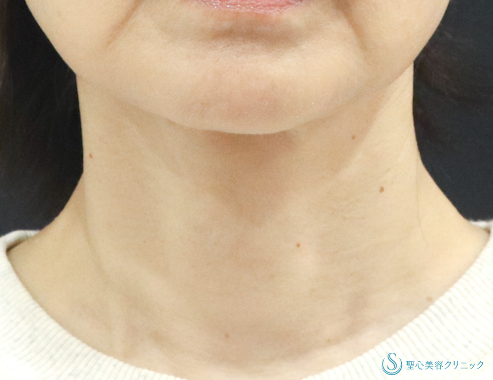 【40代女性・首のしわを薄く】プレミアムPRP皮膚再生療法（1年後） After 