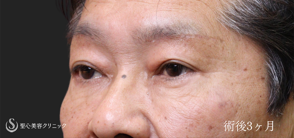 【60代男性・目周りのアンチエイジング】ハムラ法＋眉下切開法（眉下リフト）（3ヶ月後） After 