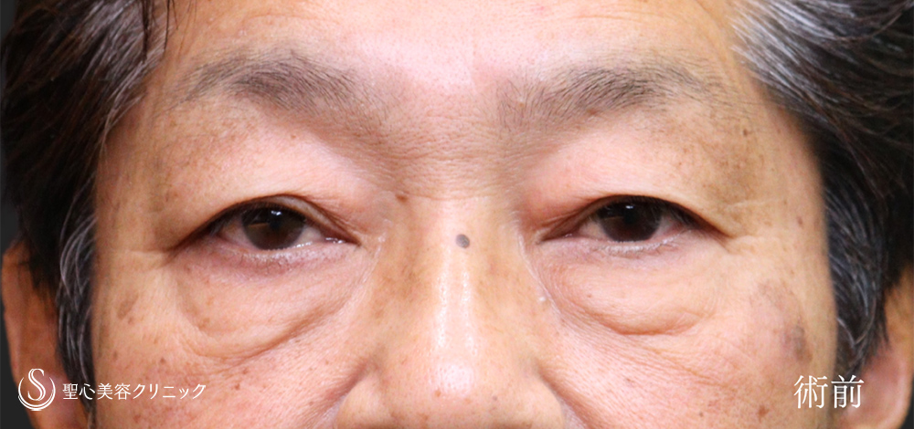 【60代男性・目周りのアンチエイジング】ハムラ法＋眉下切開法（眉下リフト）（3ヶ月後） Before 