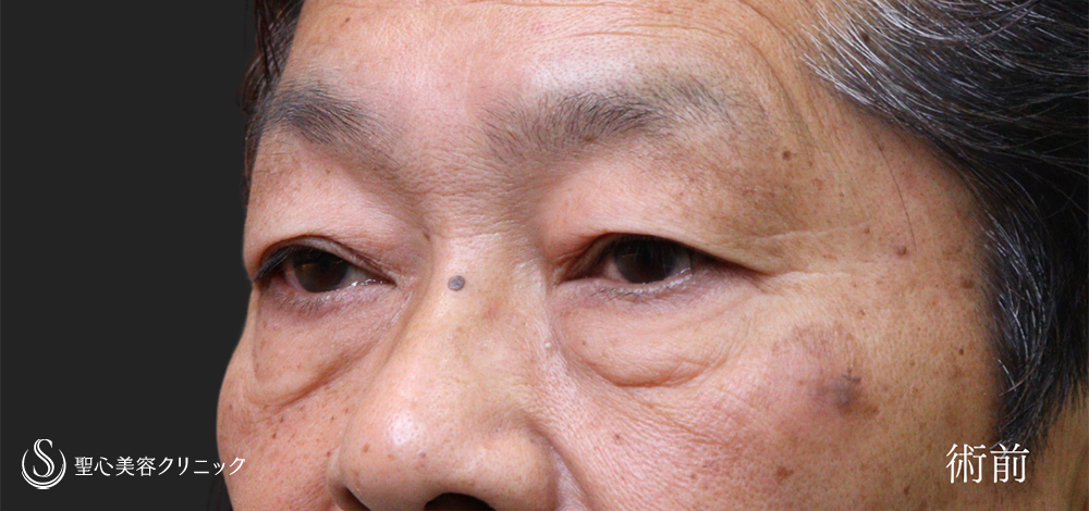 【60代男性・目周りのアンチエイジング】ハムラ法＋眉下切開法（眉下リフト）（3ヶ月後） Before 