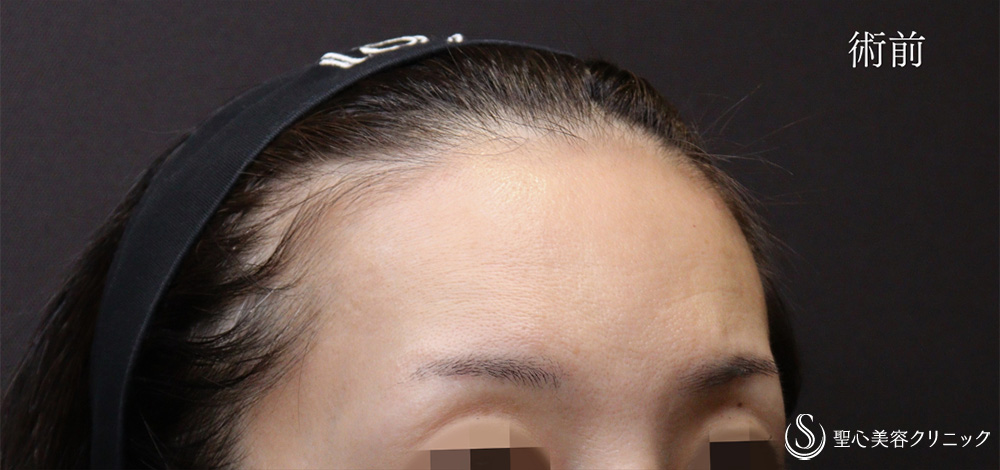 【30代女性・プレミアムPRP皮膚再生療法で額にハリを】プレミアムPRP皮膚再生療法（5ヶ月後） Before 