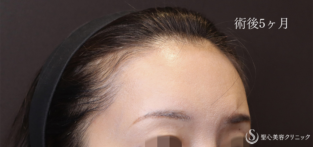 【30代女性・プレミアムPRP皮膚再生療法で額にハリを】プレミアムPRP皮膚再生療法（5ヶ月後） After 