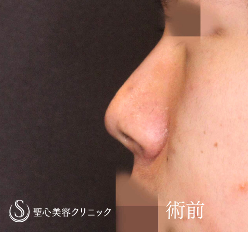 【10代男性・ストラットで鼻先をスッキリ、高く】鼻尖形成（耳介軟骨移植）＋鼻尖縮小（6ヶ月後） Before 