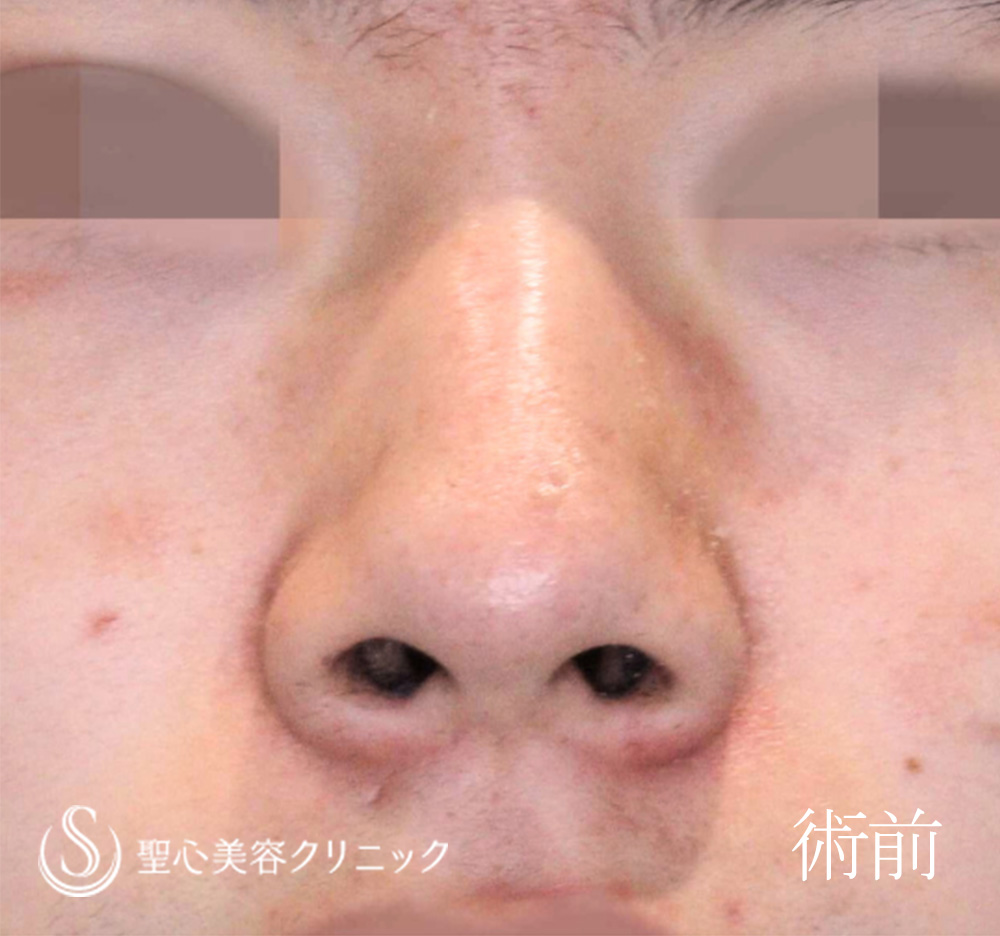 【10代男性・ストラットで鼻先をスッキリ、高く】鼻尖形成（耳介軟骨移植）＋鼻尖縮小（6ヶ月後） Before 