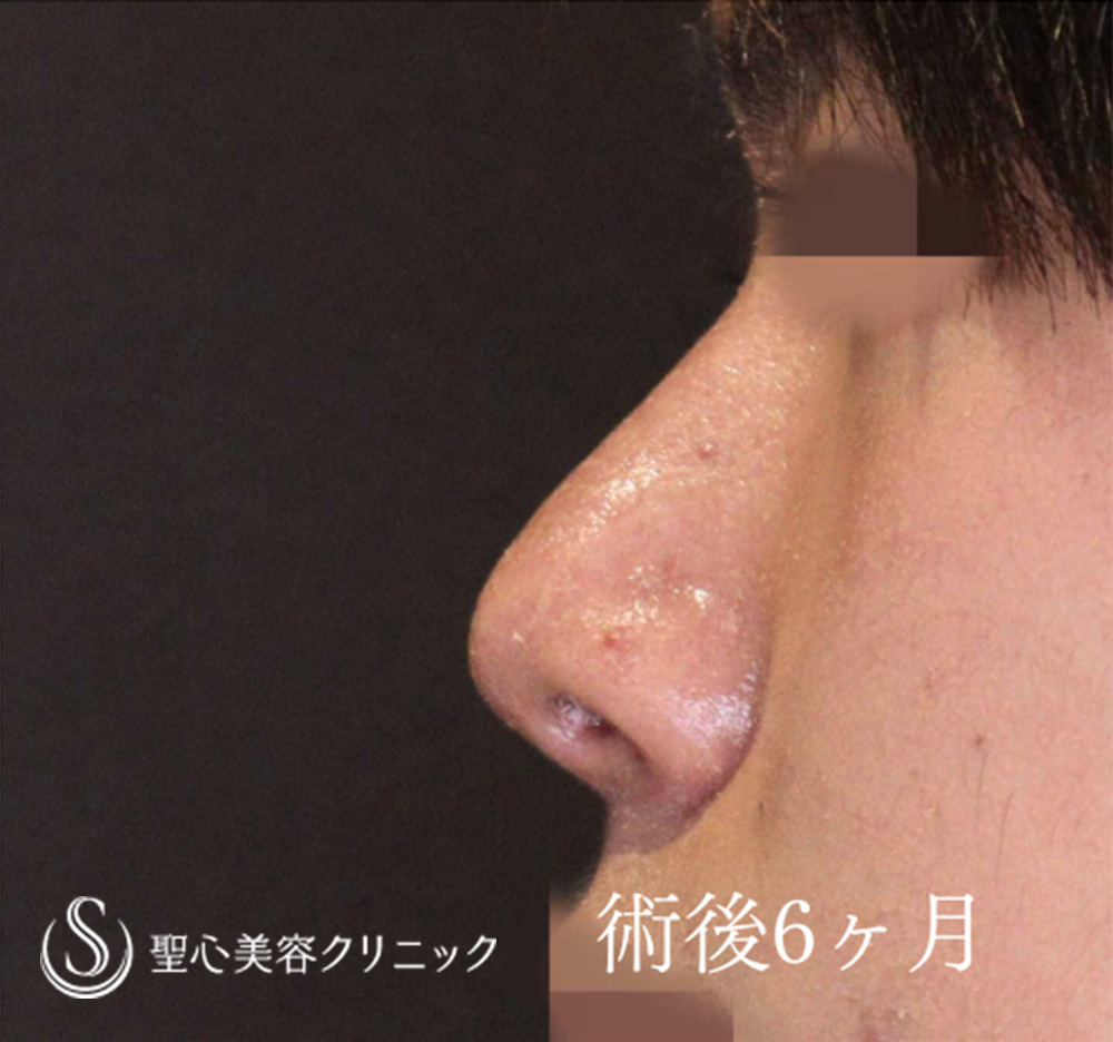 【10代男性・ストラットで鼻先をスッキリ、高く】鼻尖形成（耳介軟骨移植）＋鼻尖縮小（6ヶ月後） After 