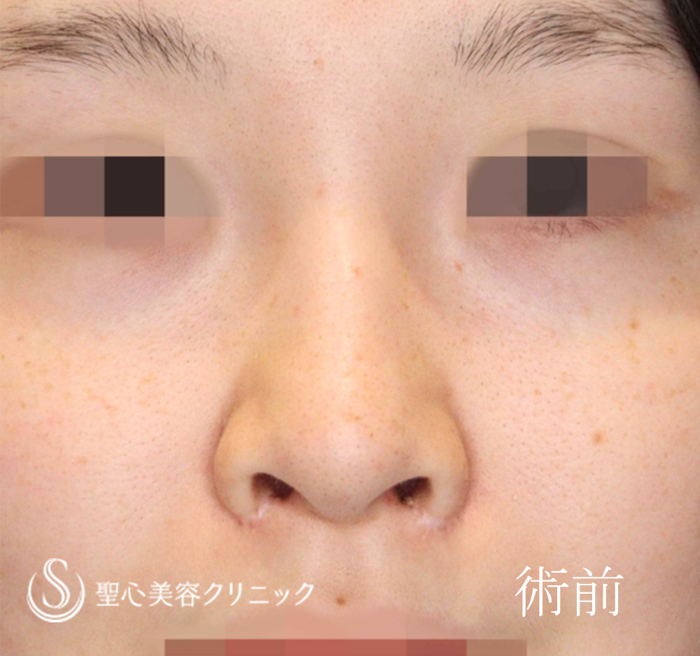 【20代女性・他院小鼻縮小後の修正】小鼻縮小（1週間後） Before 
