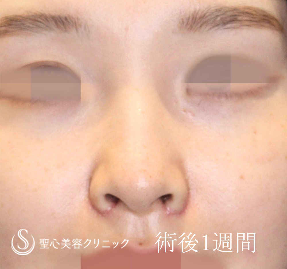【20代女性・他院小鼻縮小後の修正】小鼻縮小（1週間後） After 