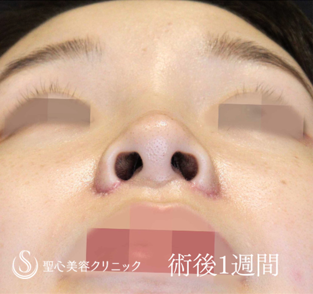 【20代女性・他院小鼻縮小後の修正】小鼻縮小（1週間後） After 
