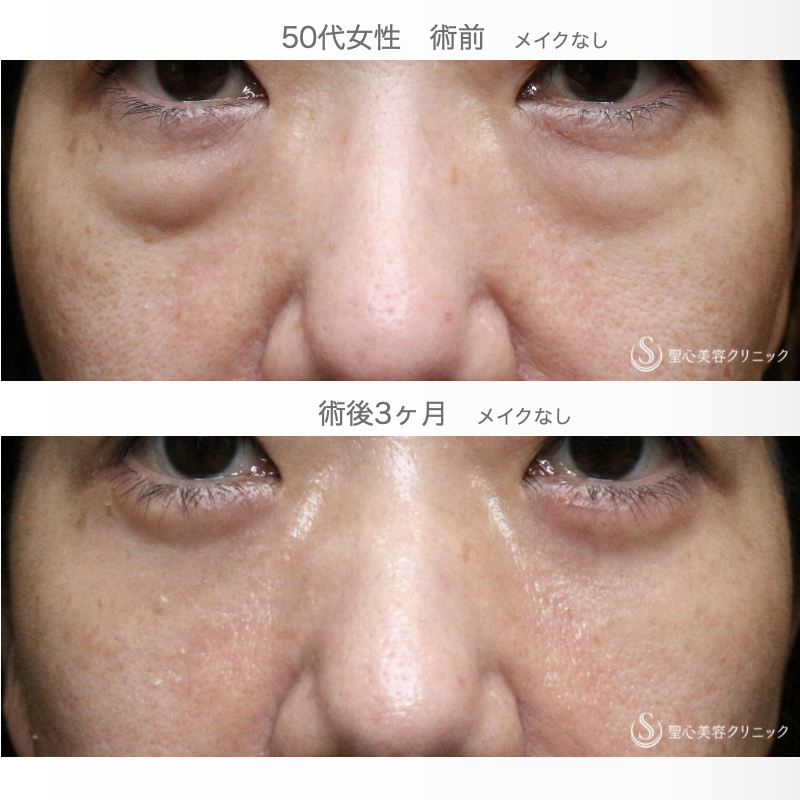 【50代女性・私が裏ハムラをしない理由】表ハムラ+α法「Ver.3」単独例（直後~3ヶ月後） Before 