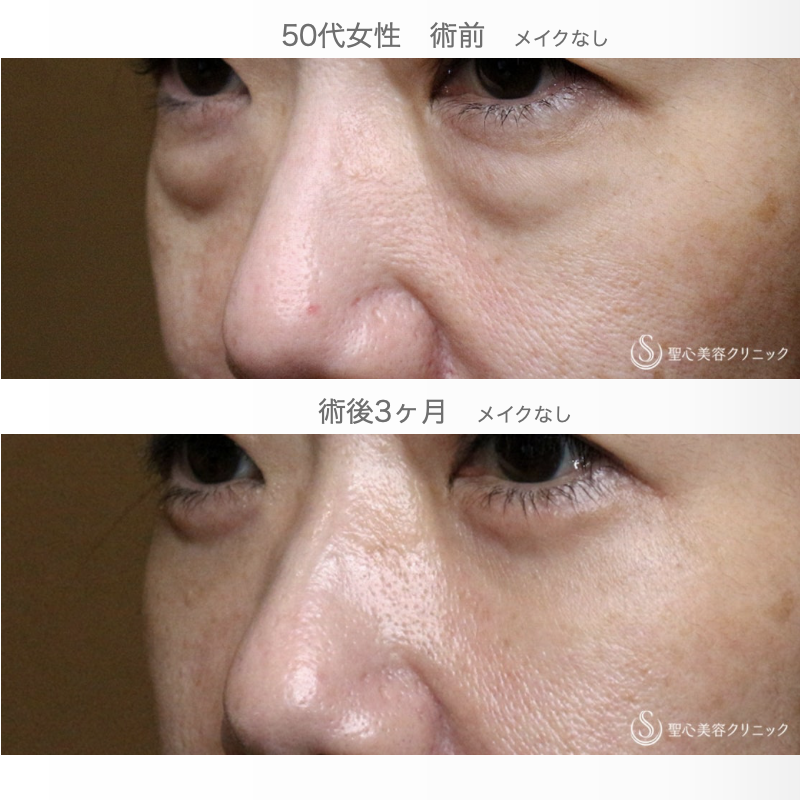 【50代女性・私が裏ハムラをしない理由】表ハムラ+α法「Ver.3」単独例（直後~3ヶ月後） After 