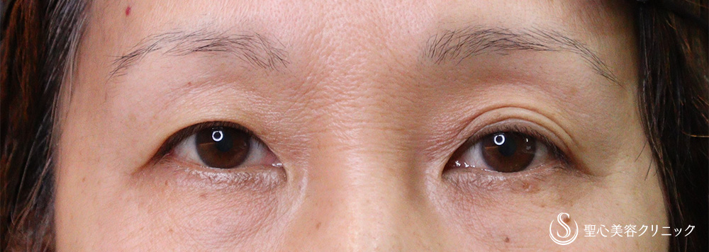 【50代女性・まぶたのたるみ、左右差】眉下切開法（眉下リフト）（11ヶ月後） Before 